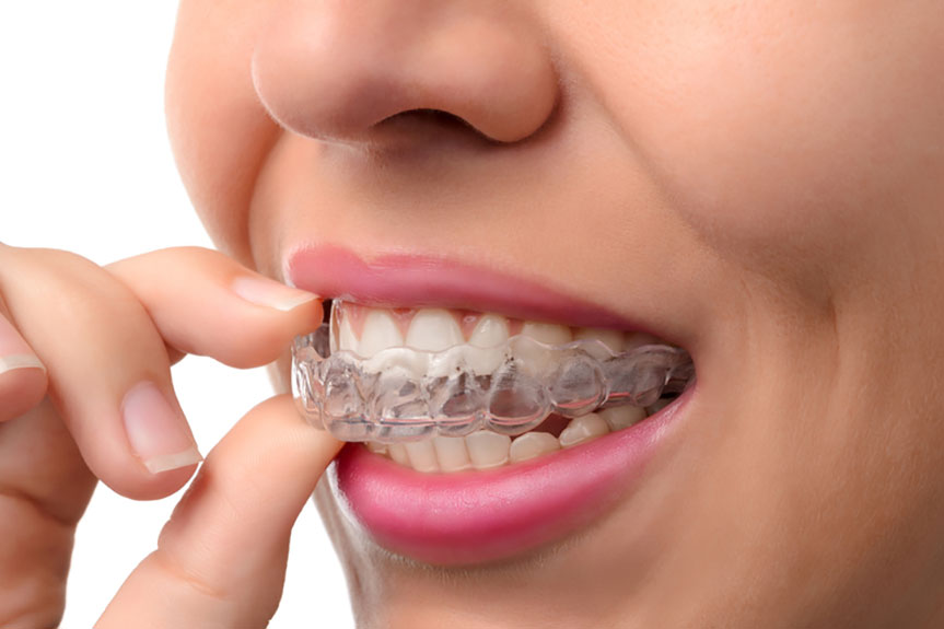 Tips for Cleaning Teeth While Wearing Braces
